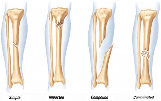 Four different kinds of fracture