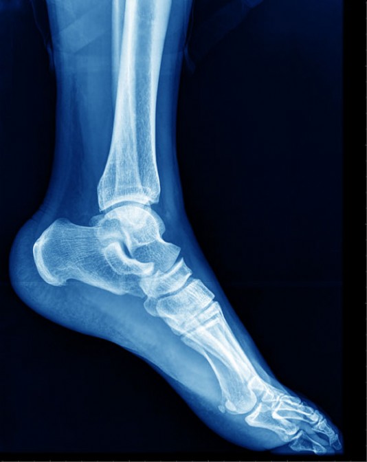 X-ray photo showing the bones in a foot