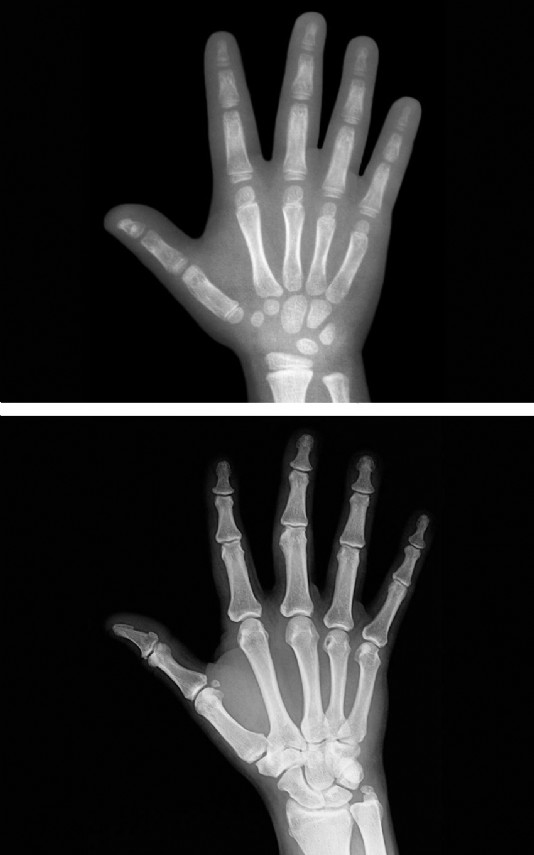 X-rays of a baby's (top) and adult's hand (above)