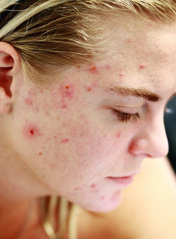 A girl with acne