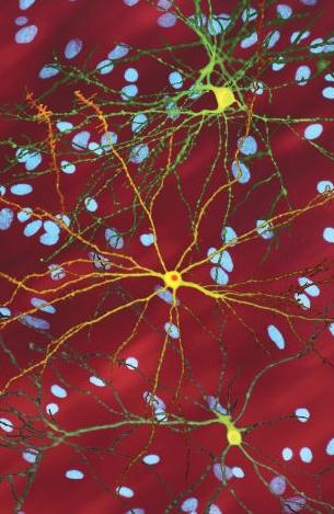 Neuron in brain affected by Huntington's disease