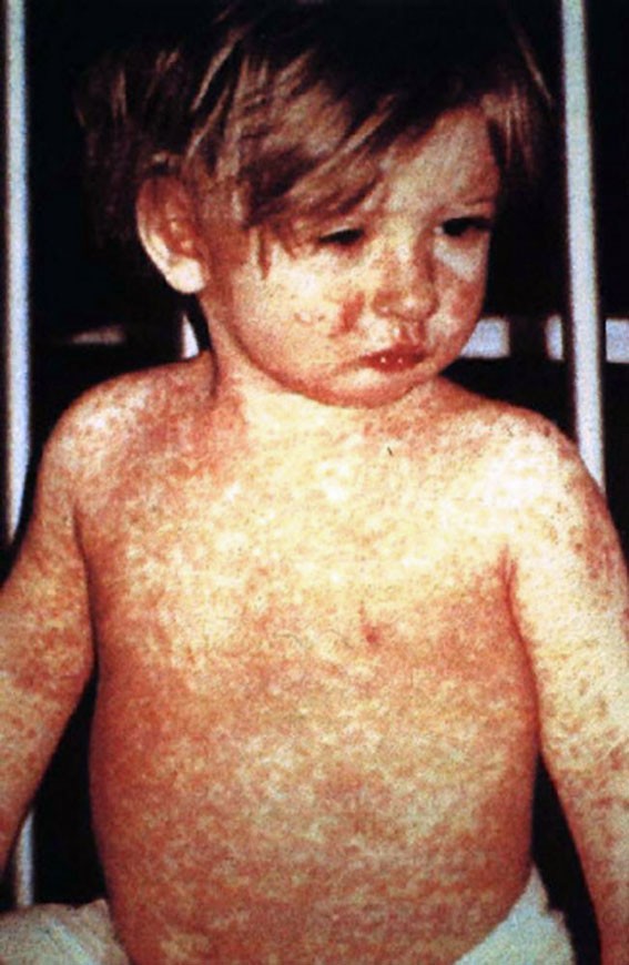 Child with measles
