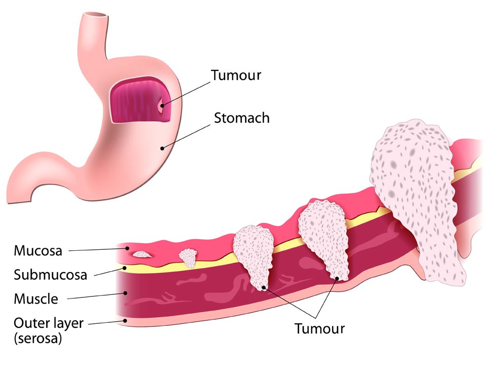 Stages of stomach cancer