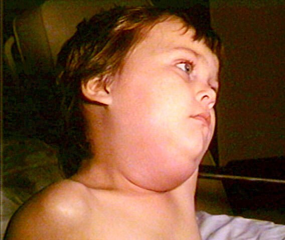 A boy with mumps 