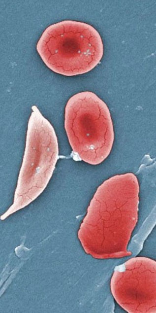 Sickle-cell anaemia 