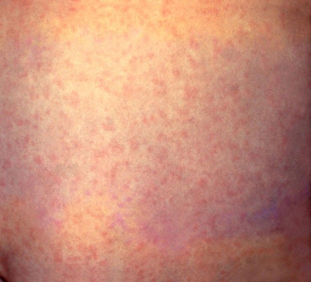 Rubella rash on the abdomen (tummy) 
