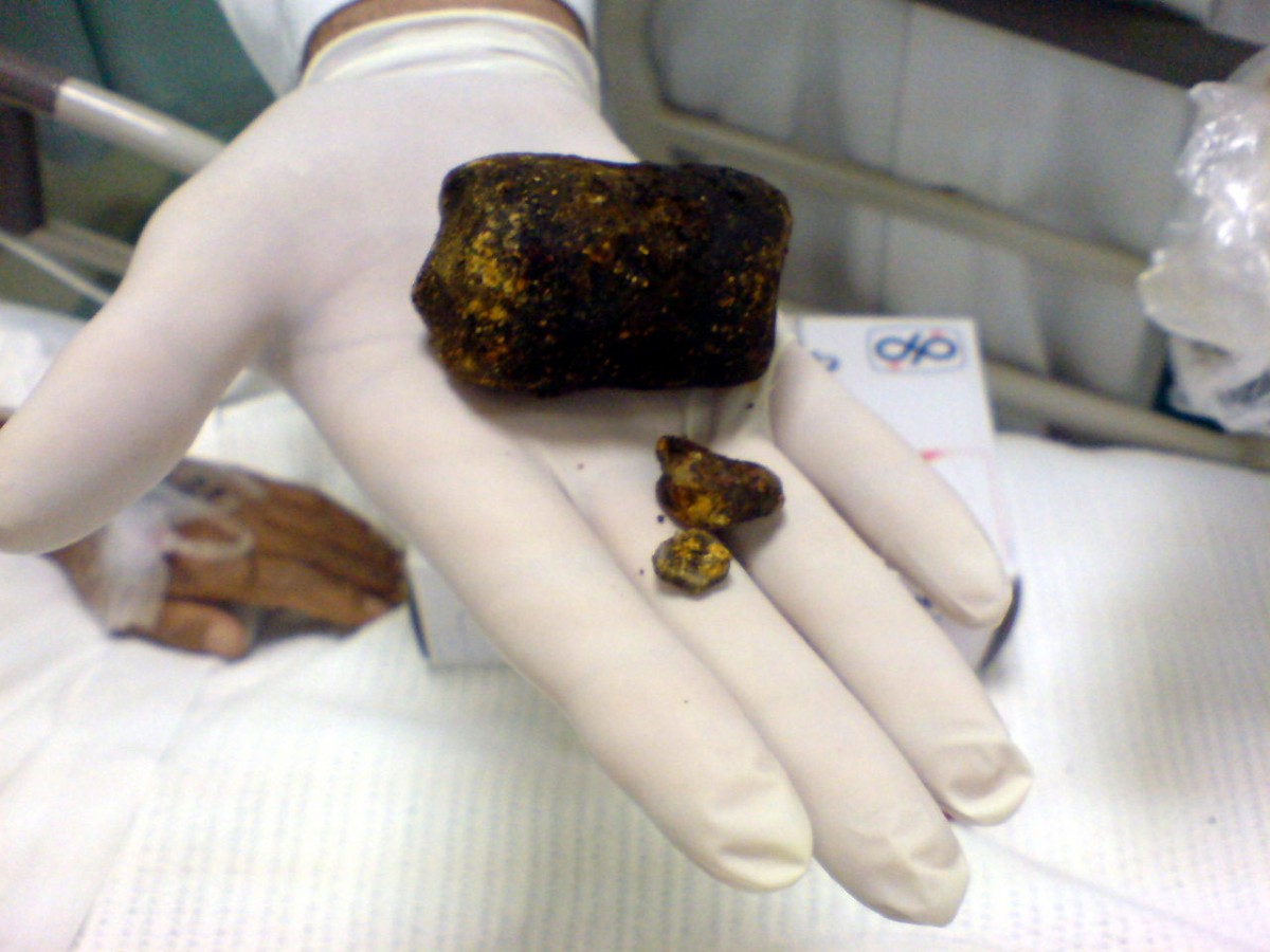 Gallstones removed from a patient’s gall bladder 