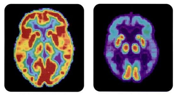 Scans of a normal brain (left), Alzheimer’s (right) 