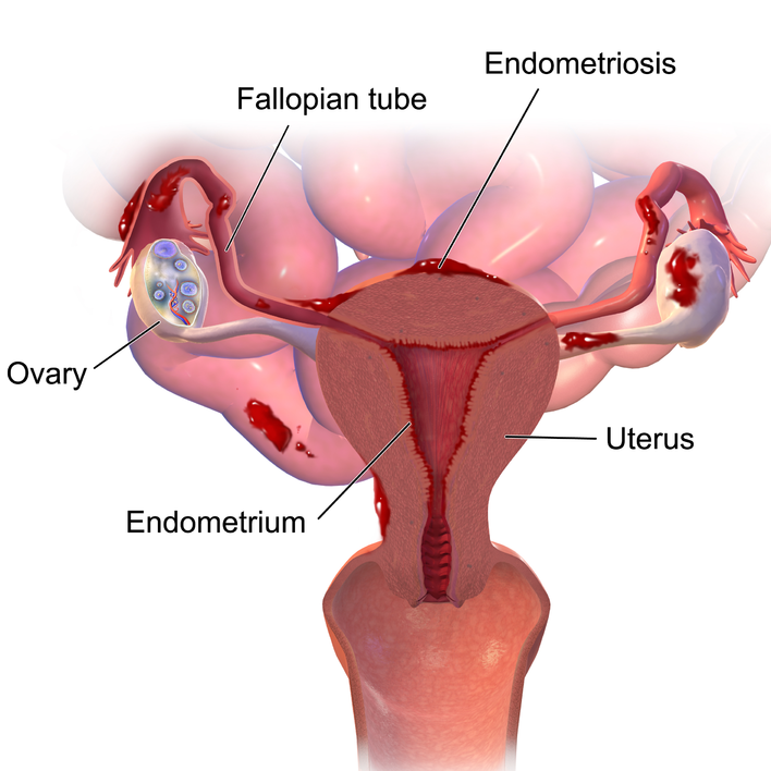 Places where endometriosis tissue may form