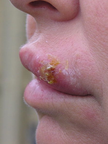 A cold sore