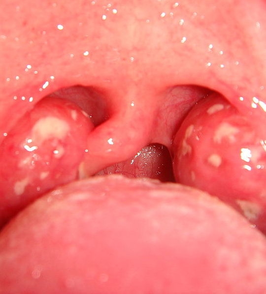 Swollen tonsils, a symptom of tonsillitis