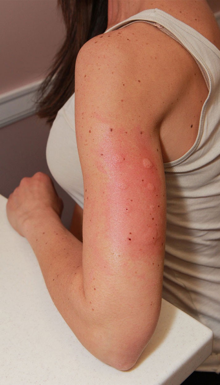 Skin prick test for allergies