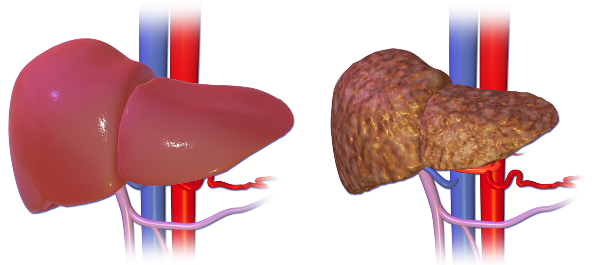 Healthy liver (left) and liver cirrhosis (right)
