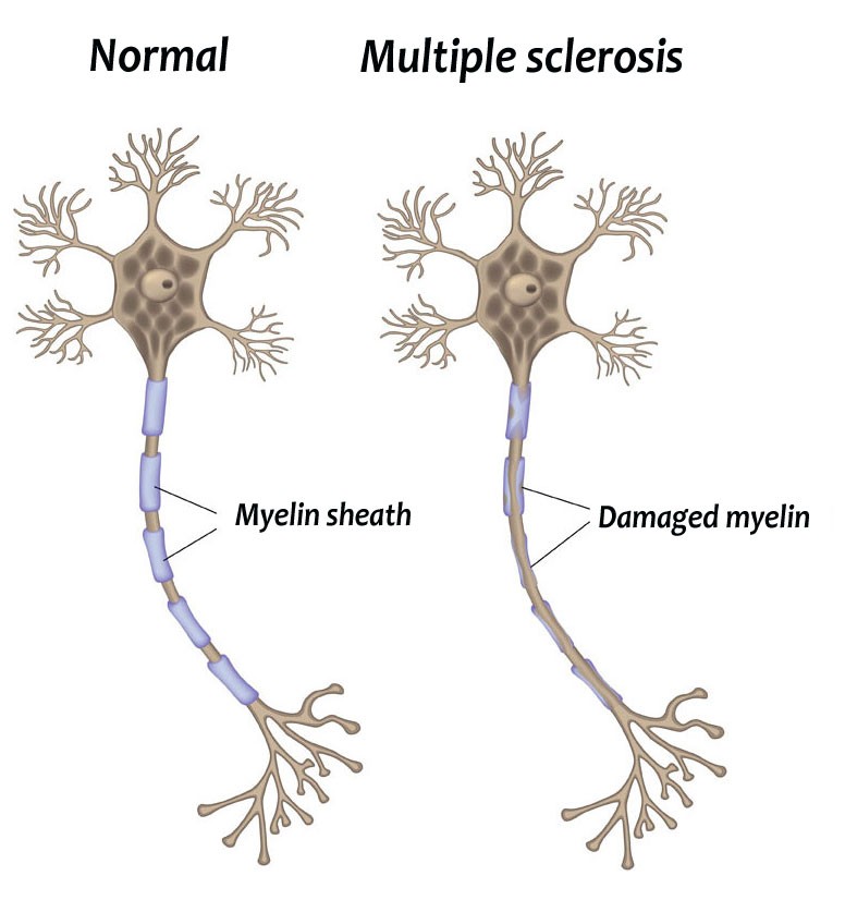 MS damages myelin covering nerve fibres