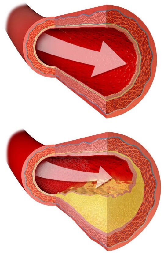 Coronary artery (lower diagram) clogged with plaque