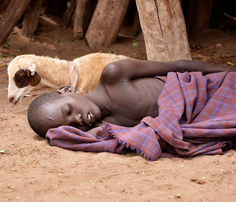 Child with malaria in Ethiopia