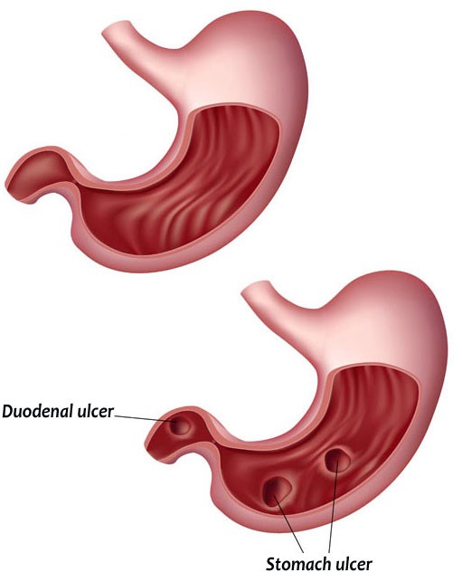 Peptic ulcers