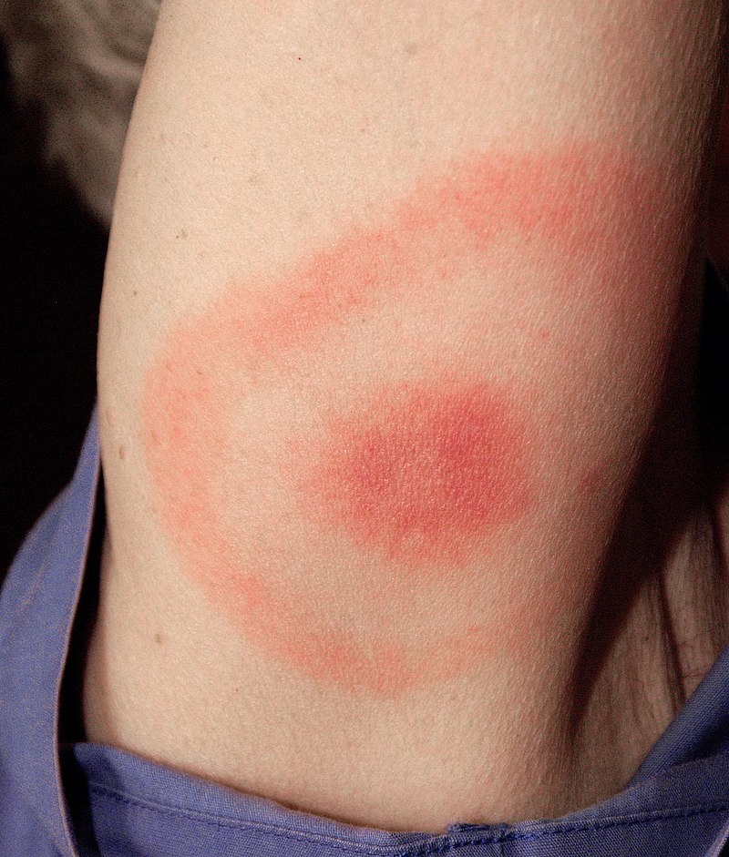 Rash of someone with Lyme disease