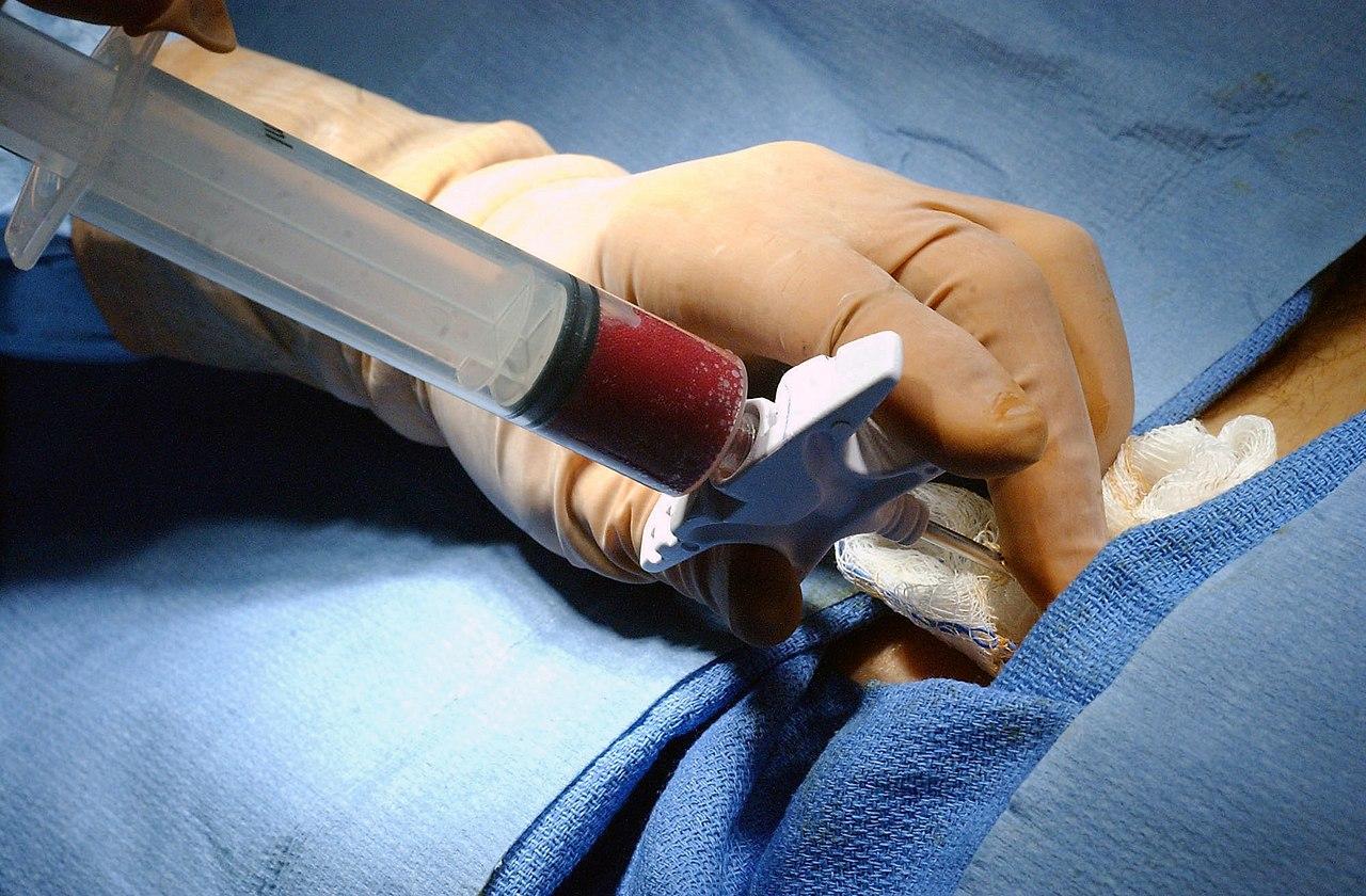 Bone marrow is extracted from a donor