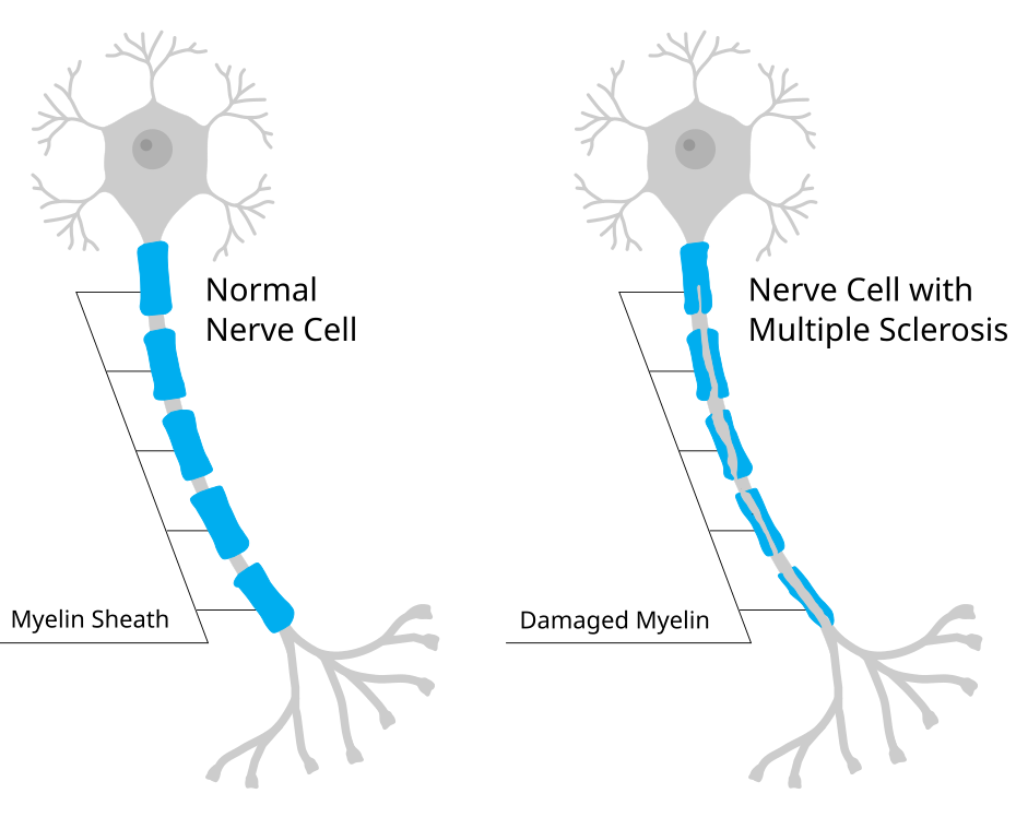 A normal nerve cell compared to one with MS