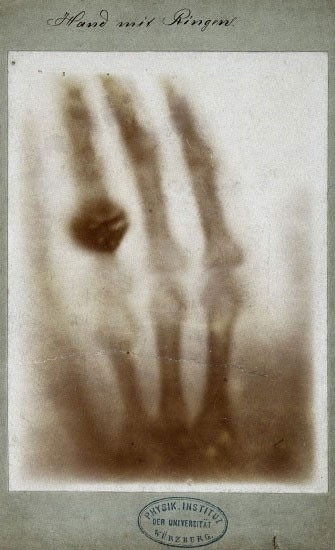 The first medical X-ray, made in 1895