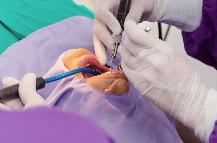 Cleaning teeth with an ultrasound tool