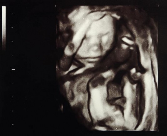 An ultrasound image of a baby in the womb