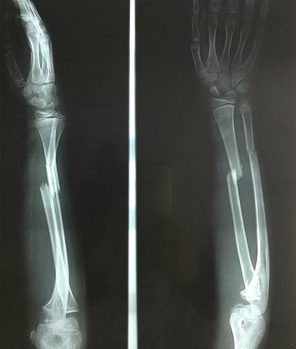 X-rays of fractured arm bones