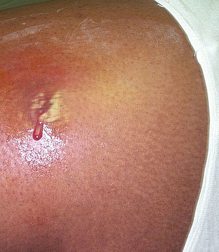 Pus, which contains phagocytes, oozing from an abscess