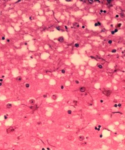 Holes in the brain tissue of a cow, caused by prions