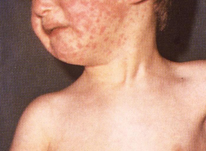 A boy with measles