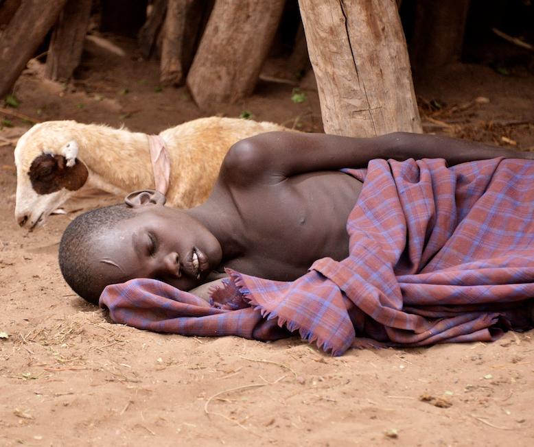 Child with malaria in Ethiopia