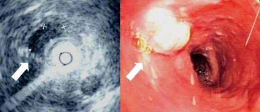 Endoscopic ultrasound image of the oesophagus