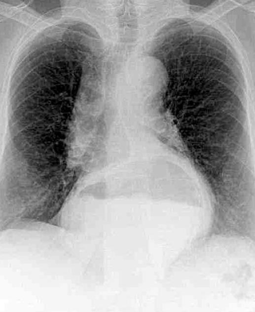 A chest X-ray image (radiograph) of a woman
