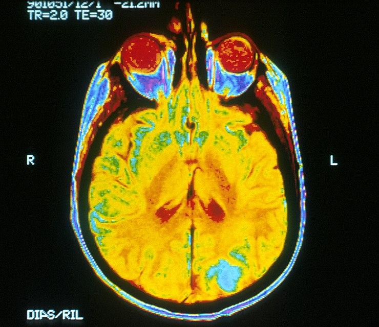 An image of a human brain using an MRI scanner