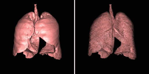 3D images of the lungs created from CT scans