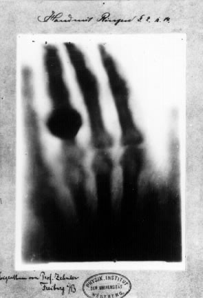 Röntgen's X-ray photograph of his wife's hand